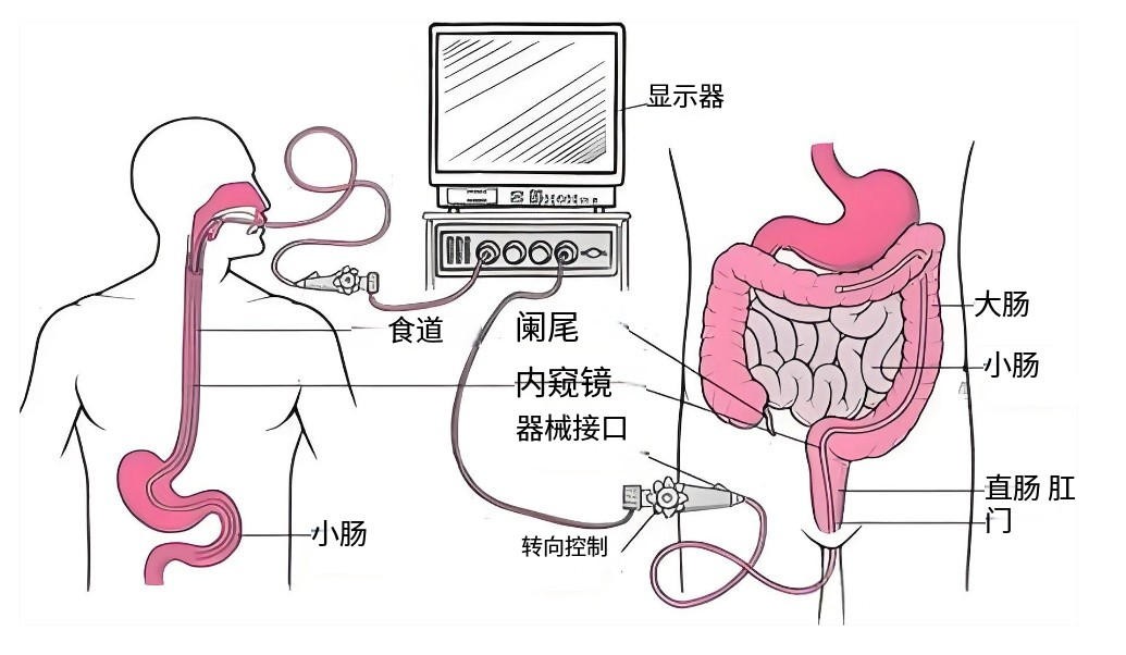 濾光片 腸胃鏡演示圖